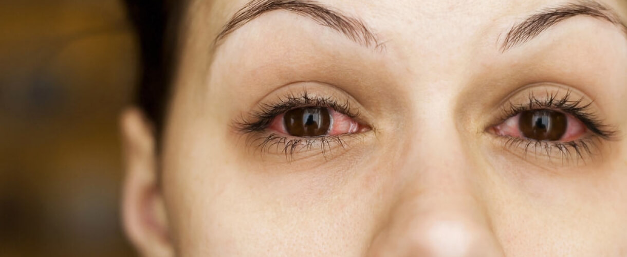 Причины аллергического кератита