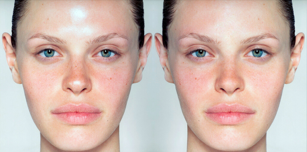 Признаки жирной кожи лица