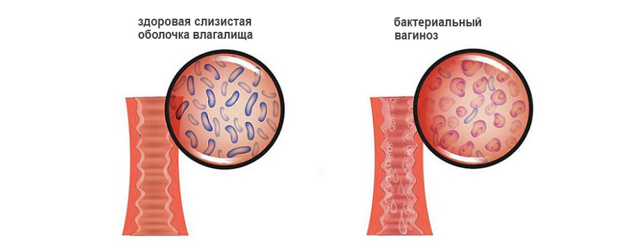 Причины бактериального вагиноза