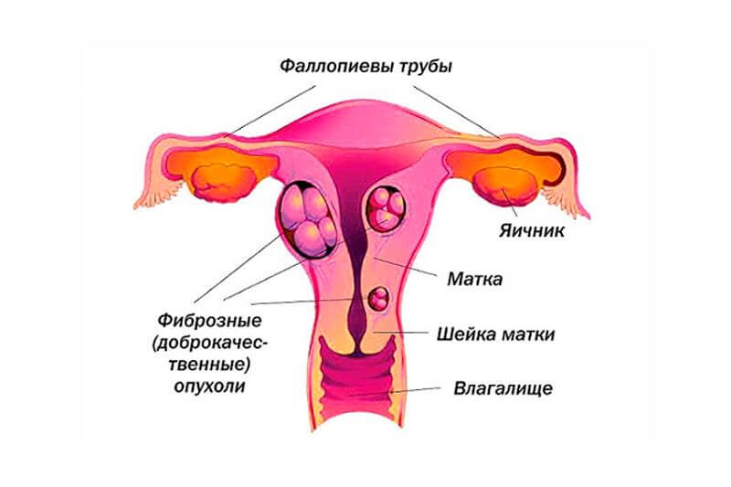 Причины фибромы матки