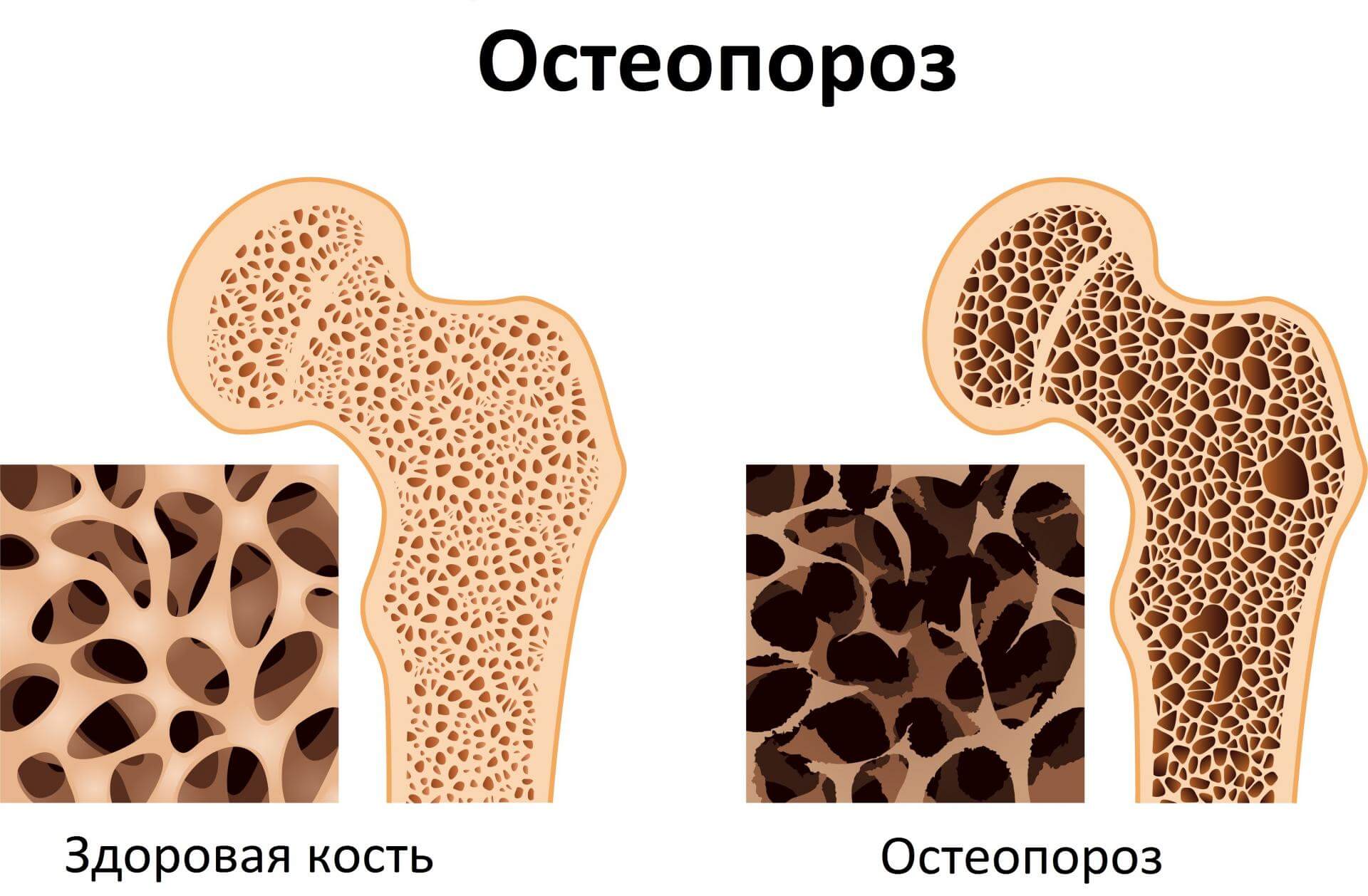 Причины остеопороза